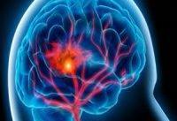 سبک زندگی نادرست علت اصلی ۹۰ درصد سکته