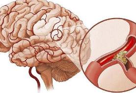 آمار سکته مغزی در ایران | چقدر برای رساندن بیمار به بیمارستان تخصصی فرصت داریم؟