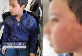 تنبیه بدنی دانش‌آموز ۱۰ ساله توسط معلم ورزش (+عکس)