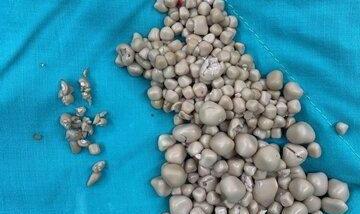کشف معدن سنگ از بدن یک زن!/ دشمنی با آب کار دست این زن داد