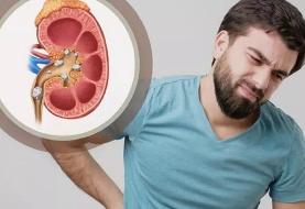 علل به وجود آمدن سنگ کلیه (فیلم)