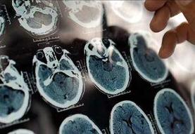 کلید مولکولی آلزایمر پیدا شد /  راهی جدید برای نجات حافظه