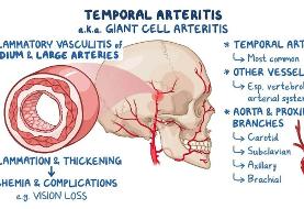 چرا سردرد شقیقه پس از ۵۰ سالگی همیشه باید جدی گرفته شود؟