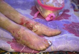 ۱۰۰ خانواده در ایران حداقل ۲ فرزند مبتلا به ای‌بی دارند | بیماران پروانه‌ای چند سال عمر می‌کنند؟