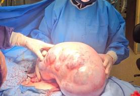 خارج‌ کردن توده ۱۰ کیلویی از شکم یک بیمار در کرج