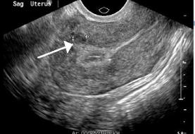 ارتباط فیبروم رحمی با بیماری قلبی در زنان