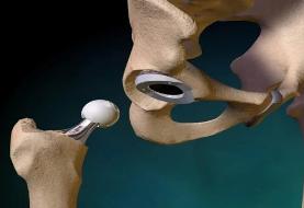 ریکاوری پس از تعویض مفصل ران؛ تمرینات ورزشی و نکات کلیدی (+تصاویر حرکات)