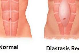 شکاف عضلات راست شکمی پس از زایمان: از تحقیقات پایه تا عمل بالینی + عکس