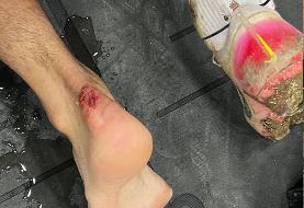 عکس| صحنه دلخراش از پای بازیکن خیبر/ کارت قرمز داشت؟