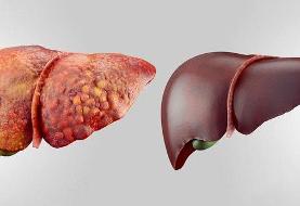 راه درمان کبد چرب مشخص شد؛ معجزه می‌کند!