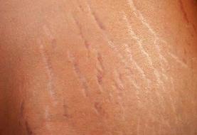 درمان ترک‌های پوستی؛ «درمان قطعی» وجود دارد؟