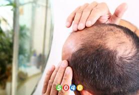 درمان ریزش مو در مردان و خداحافظی با طاسی و کچلی