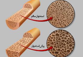 چگونه به پوکی استخوان مبتلا نشویم؟ | روش اصلی تشخیص پوکی استخوان