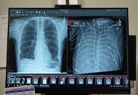 مردی ۴۸ ساعت بدون ریه زنده ماند