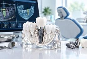 چرا قیمت ایمپلنت دیجیتال در مطب‌های تهران یکسان نیست؟
