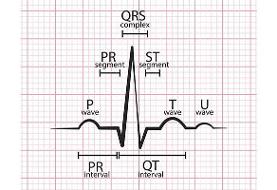 نشانگان QT طولانی چیست؟