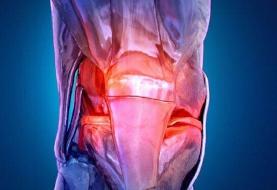 آرتروز دیگر بیماریِ سنین بالا نیست؛ زنگ خطر درد و ناتوانیِ زودرس برای جوانان