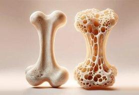 راهکارهایی برای پیشگیری از پوکی استخوان