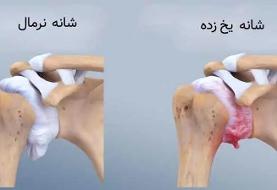 آیا سرما باعث درد شانه می‌شود؟/ شانه یخ‌زده چیست؟/ این درد درمانی دارد؟